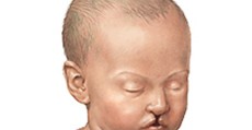 cleftlip cleftlip